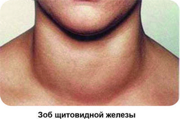 Зоб щитовидной железы